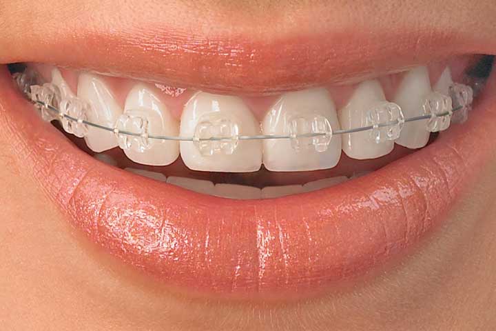 close-up clear braces