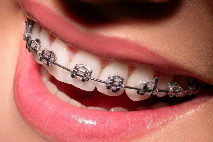close-up metal braces