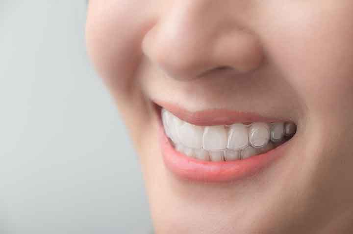 close-up clear braces